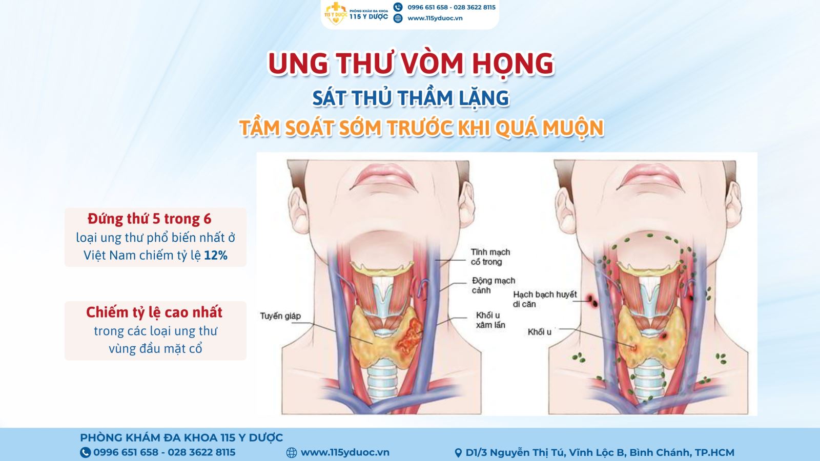 UNG THƯ VÒM HỌNG SÁT THỦ THẦM LẶNG